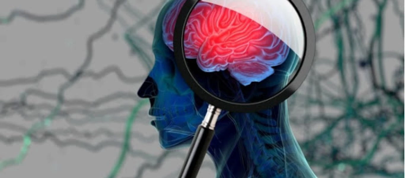 Ανεύρυσμα εγκεφάλου: Προσοχή σε αυτά τα «αθώα» πρώιμα συμπτώματα